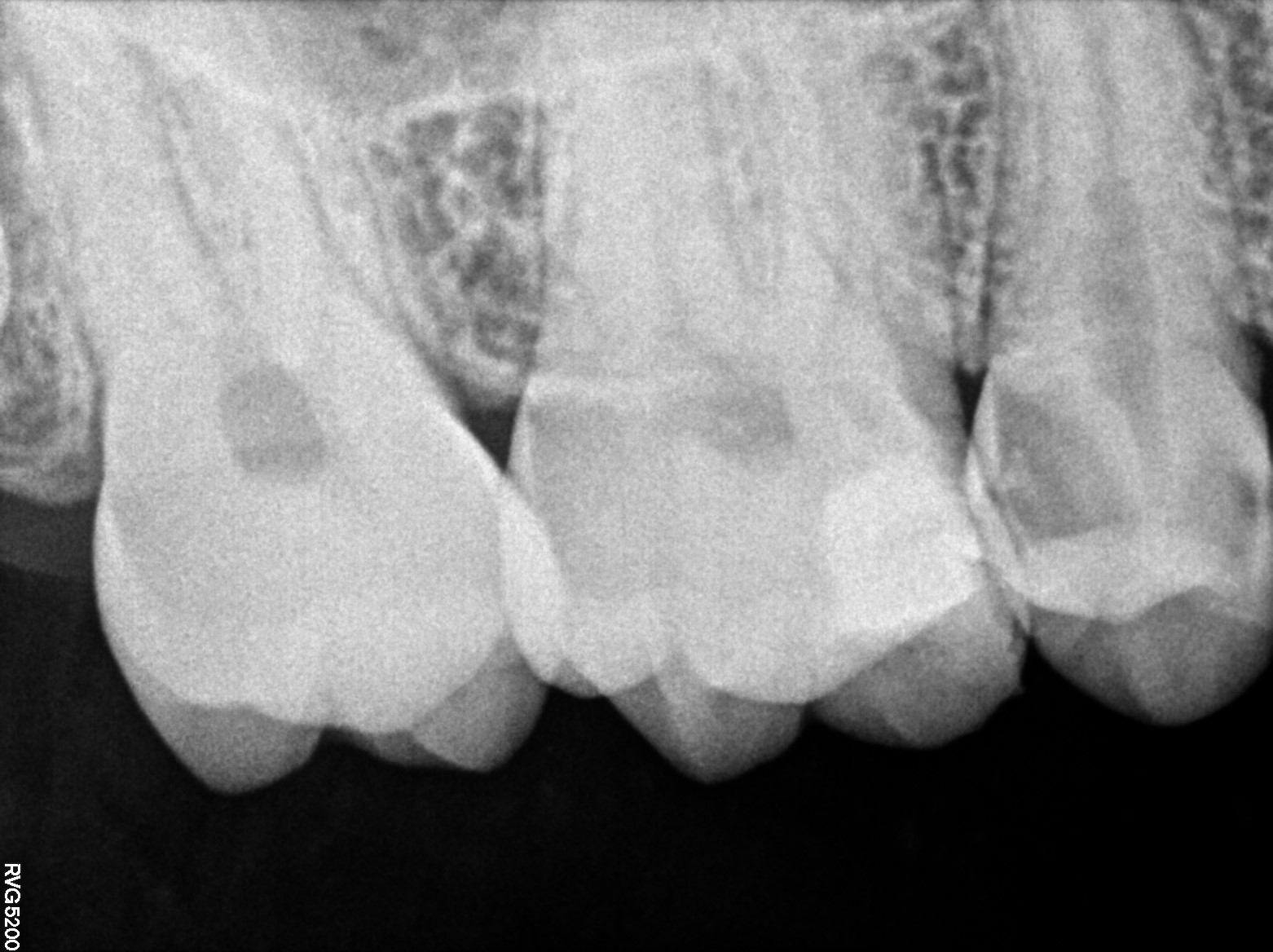 Dental X-ray